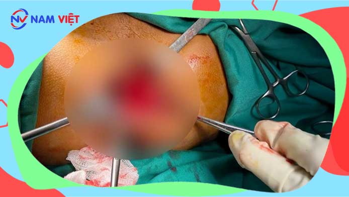 Người đàn ông sống sót kỳ diệu sau bị xà beng đâm xuyên người
