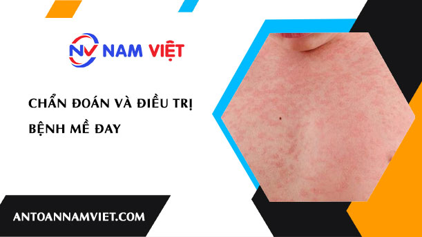 Chẩn đoán và điều trị bệnh mề đay