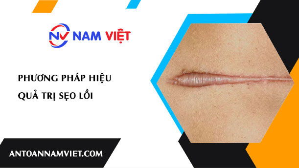PHƯƠNG PHÁP HIỆU QUẢ TRỊ SẸO LỒI
