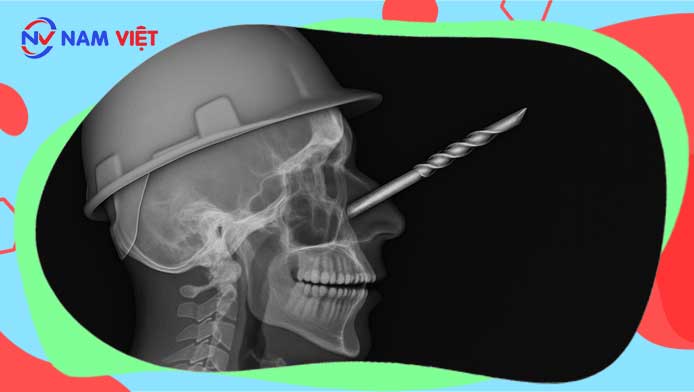 Nam công nhân bị mũi khoan đá đâm xuyên hốc mũi nguy kịch
